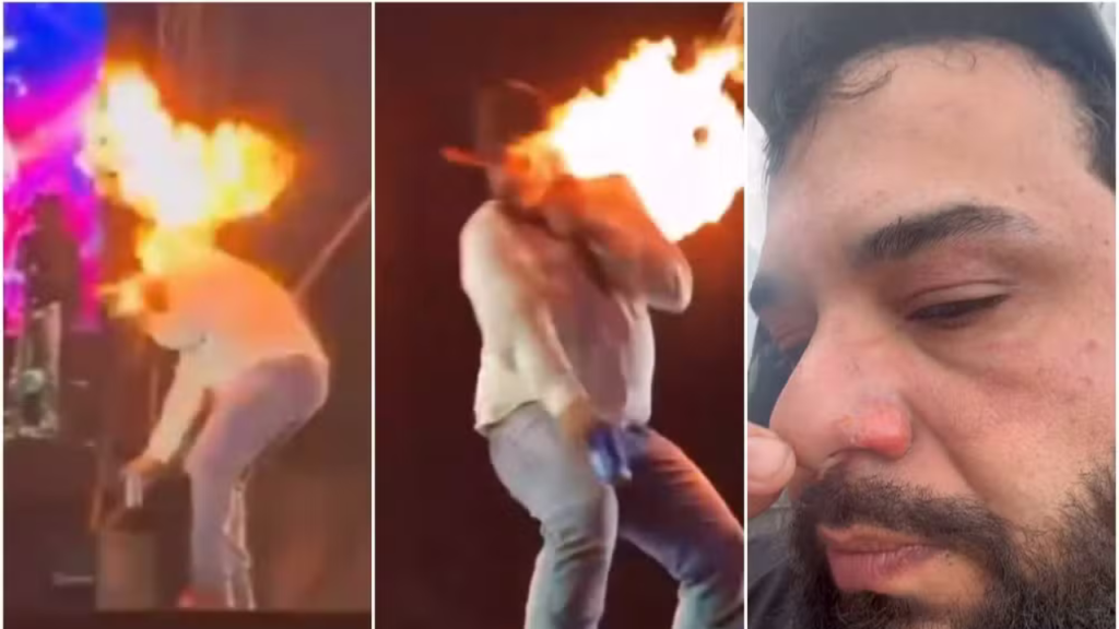 Sertanejo Léo se queima em show e mostra rosto ferido nas&nbsp;redes